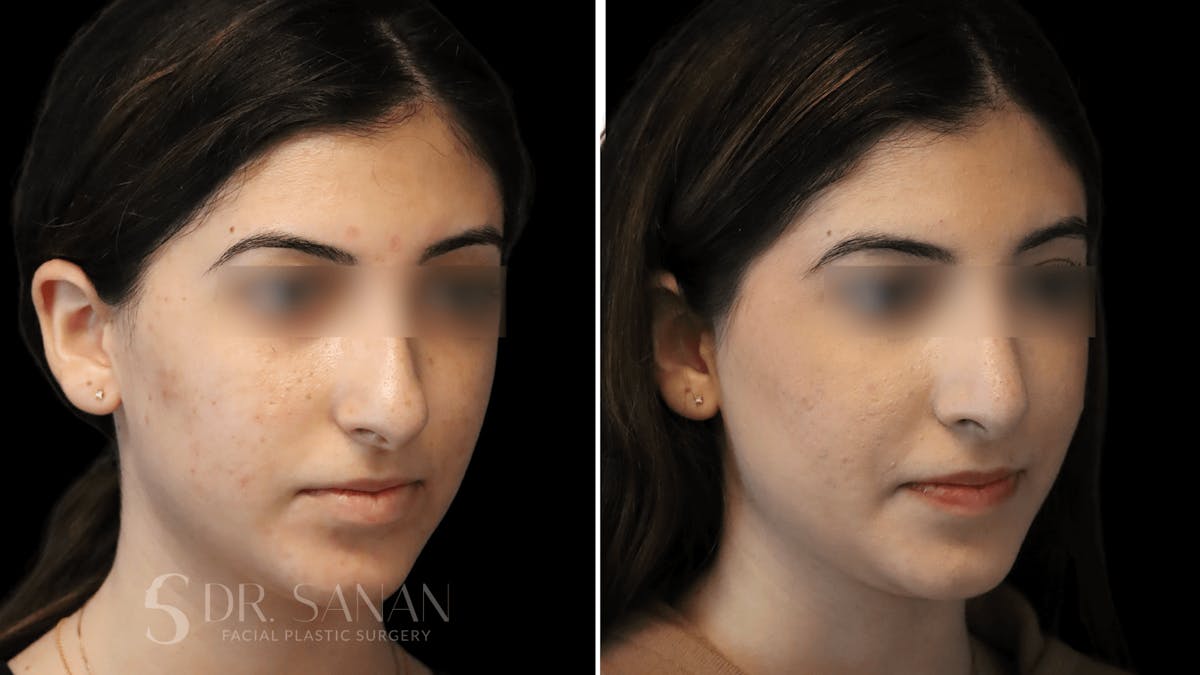 Rhinoplasty Before & After Gallery - Patient 195566 - Image 4