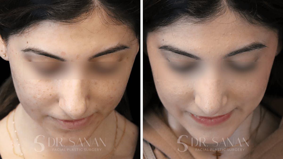 Rhinoplasty Before & After Gallery - Patient 195566 - Image 5