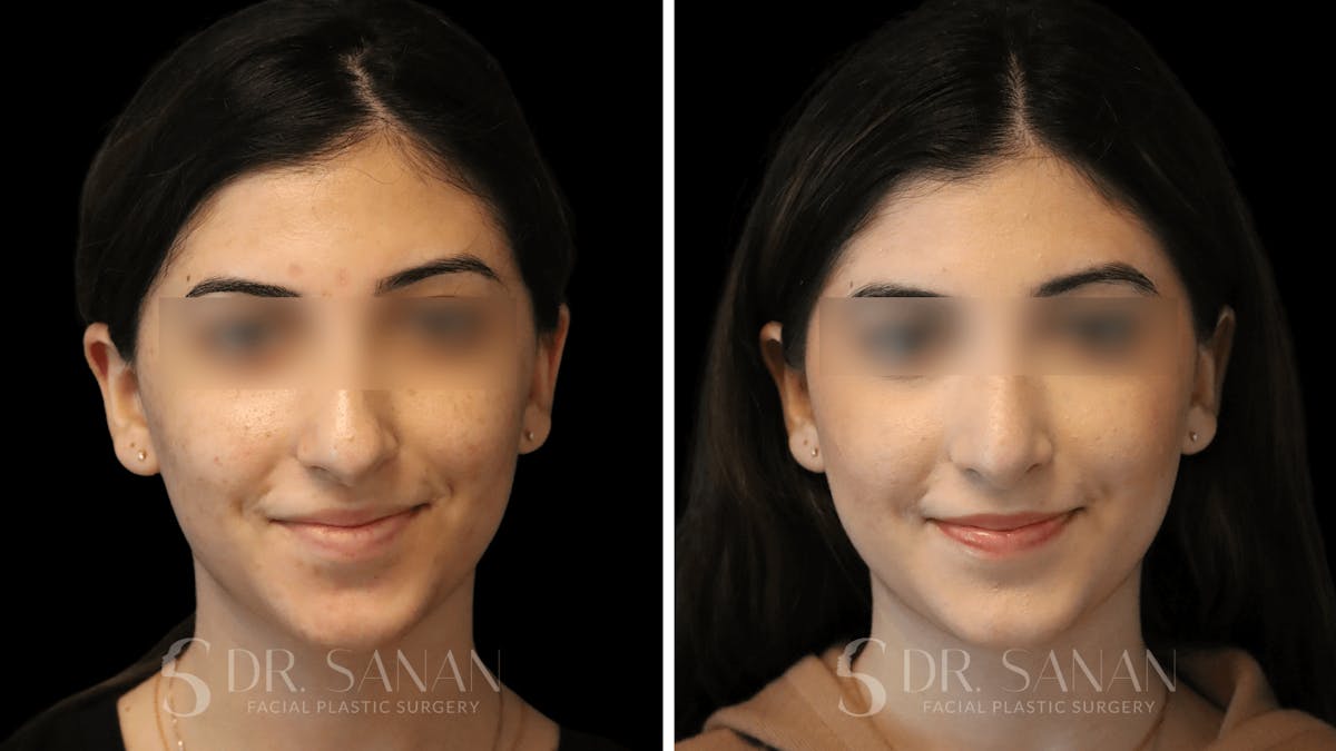 Rhinoplasty Before & After Gallery - Patient 195566 - Image 6