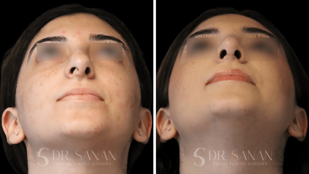 Rhinoplasty Before & After Gallery - Patient 195566 - Image 7