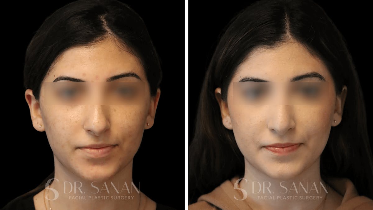 Rhinoplasty Before & After Gallery - Patient 195566 - Image 8