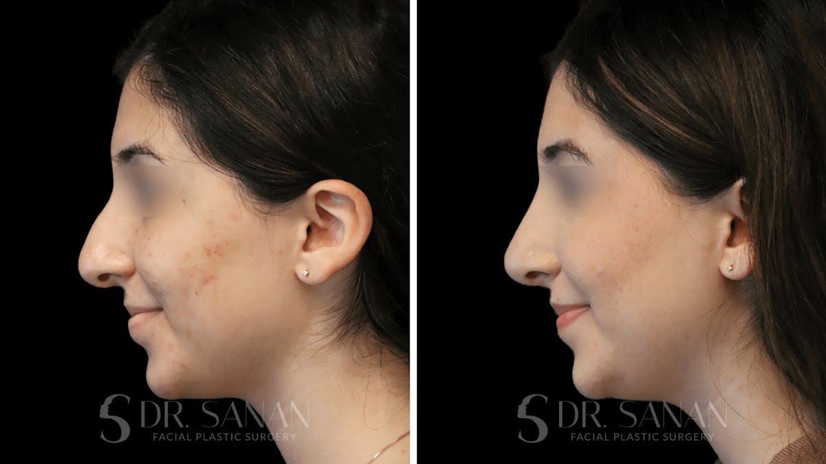 Rhinoplasty Before & After Gallery - Patient 195566 - Image 2