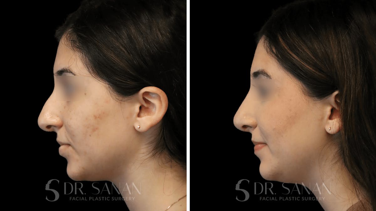 Rhinoplasty Before & After Gallery - Patient 195566 - Image 9