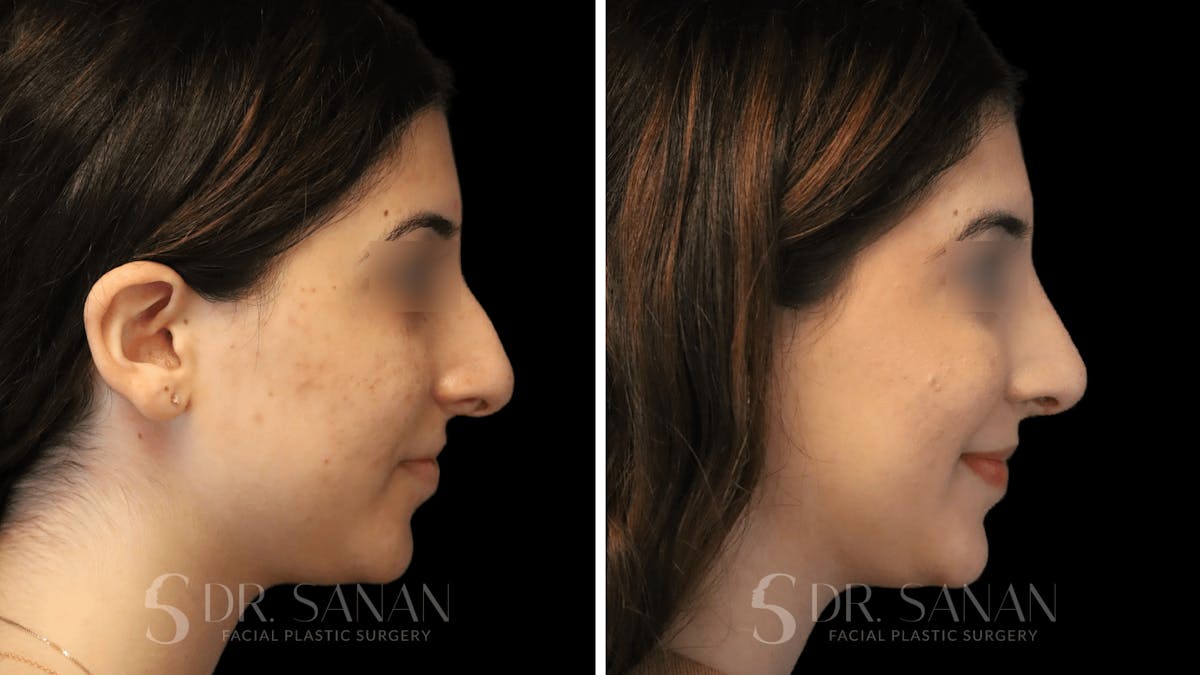 Rhinoplasty Before & After Gallery - Patient 195566 - Image 1