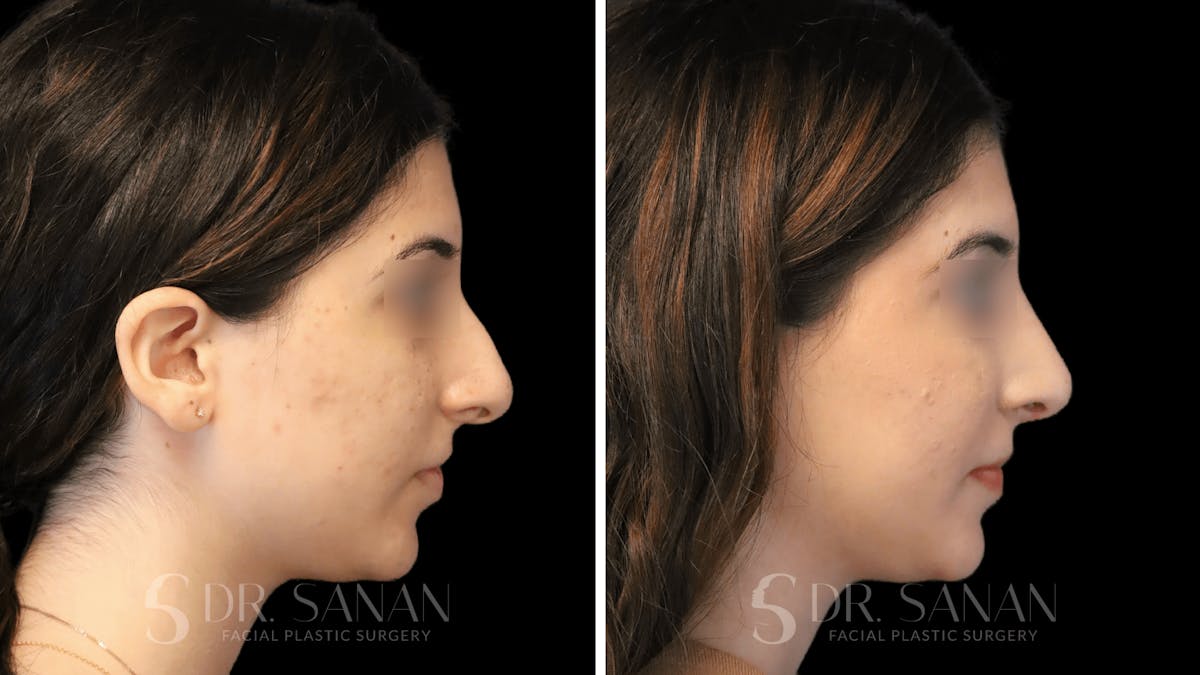 Rhinoplasty Before & After Gallery - Patient 195566 - Image 10
