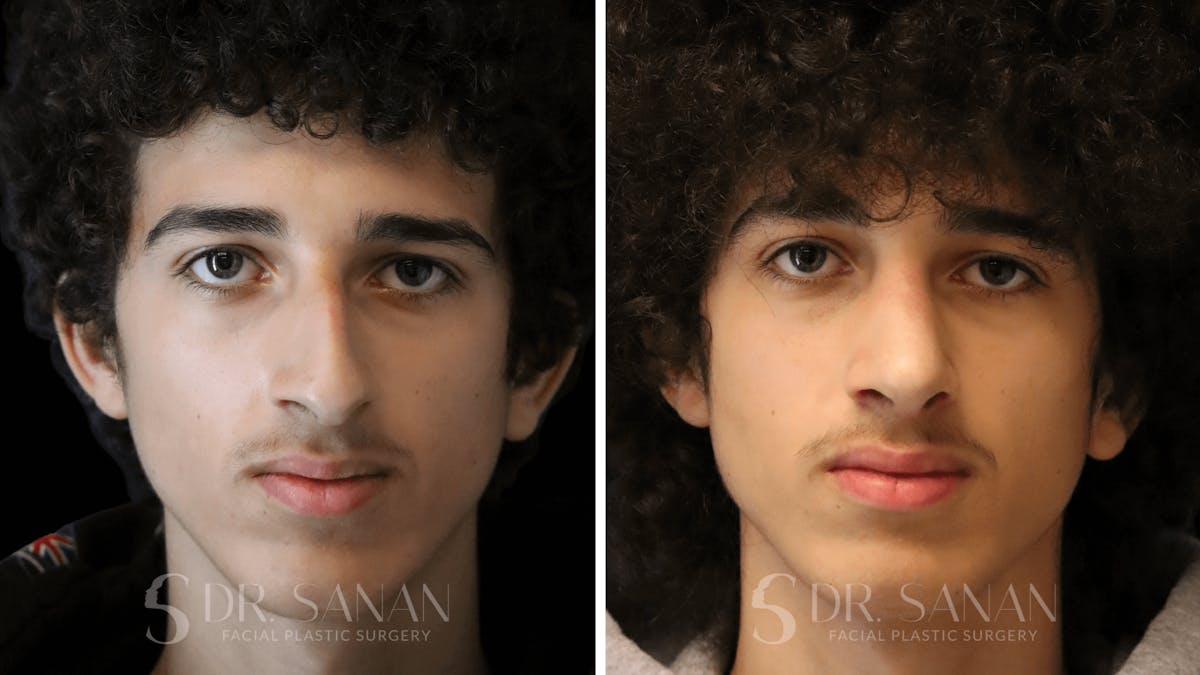 Rhinoplasty Before & After Gallery - Patient 960277 - Image 3