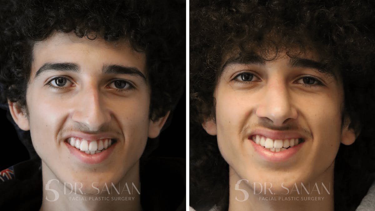 Rhinoplasty Before & After Gallery - Patient 960277 - Image 4