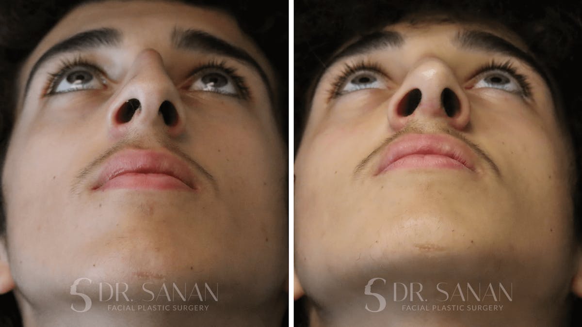 Rhinoplasty Before & After Gallery - Patient 960277 - Image 5