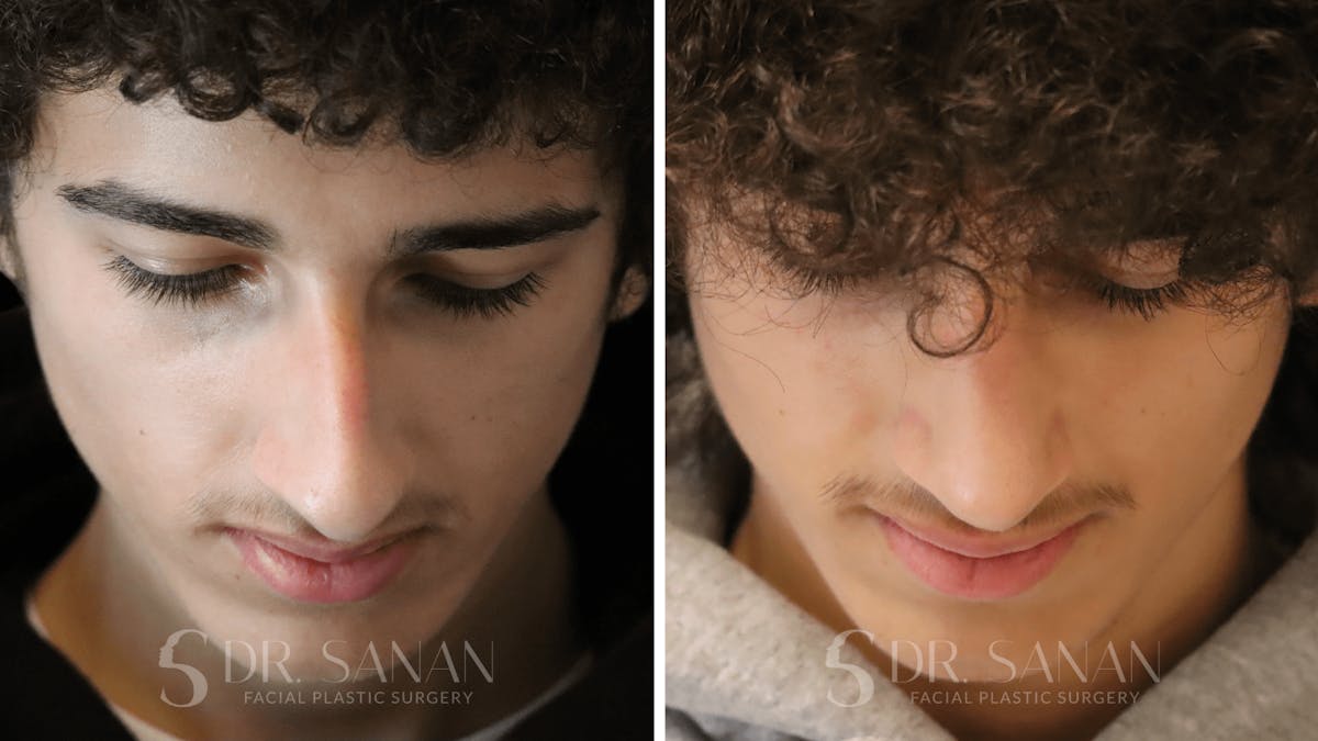 Rhinoplasty Before & After Gallery - Patient 960277 - Image 6