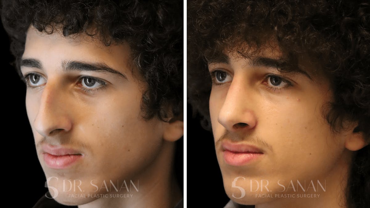 Rhinoplasty Before & After Gallery - Patient 960277 - Image 7