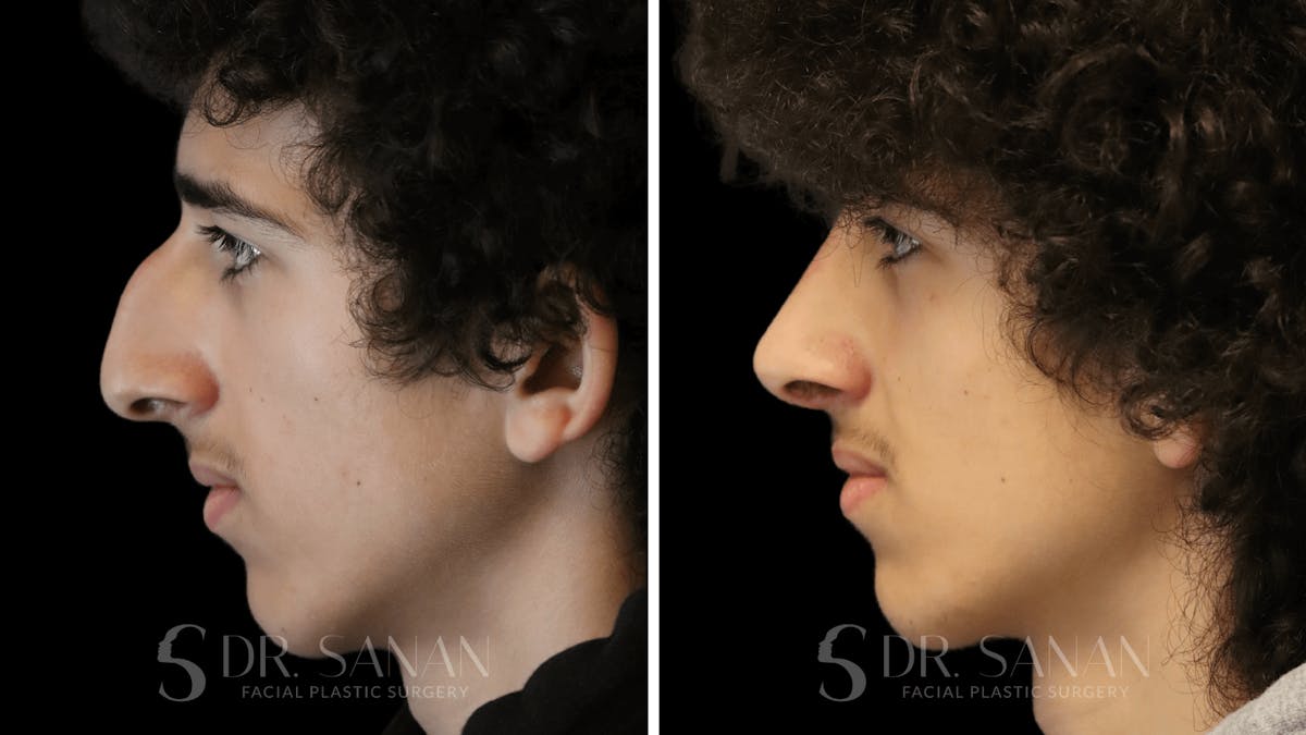 Rhinoplasty Before & After Gallery - Patient 960277 - Image 2
