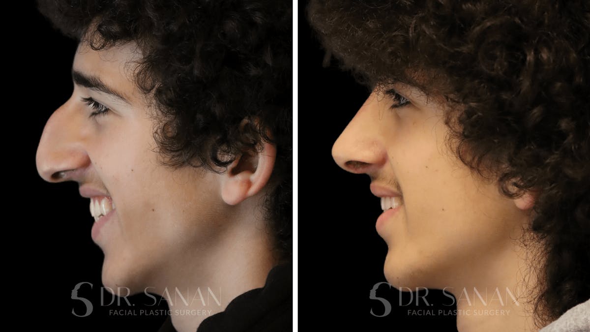 Rhinoplasty Before & After Gallery - Patient 960277 - Image 8