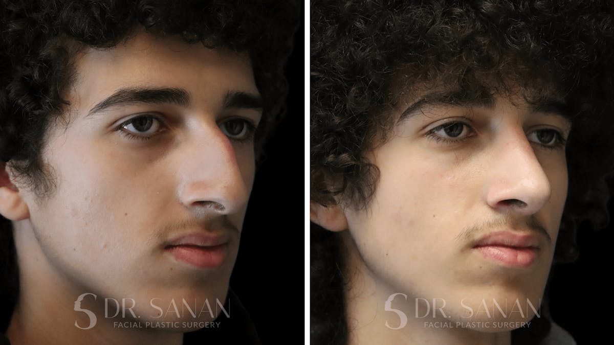 Rhinoplasty Before & After Gallery - Patient 960277 - Image 9
