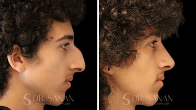 Rhinoplasty Before & After Gallery - Patient 960277 - Image 1