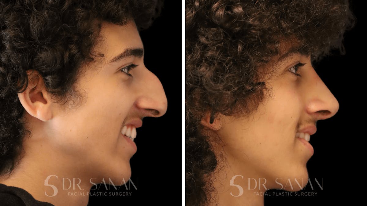 Rhinoplasty Before & After Gallery - Patient 960277 - Image 10