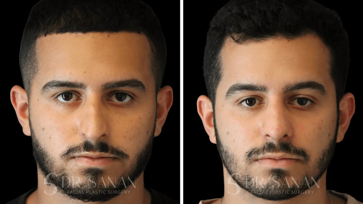 Rhinoplasty Before & After Gallery - Patient 890465 - Image 3