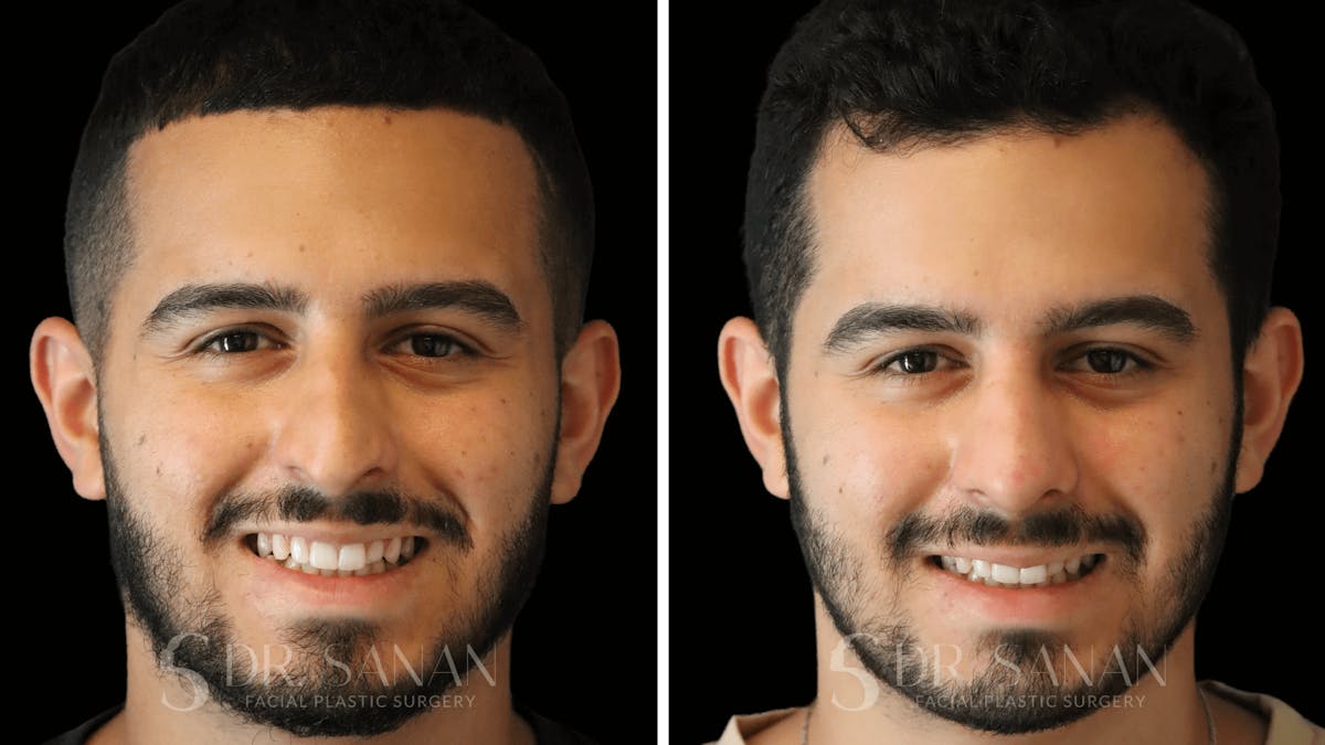 Rhinoplasty Before & After Gallery - Patient 890465 - Image 4