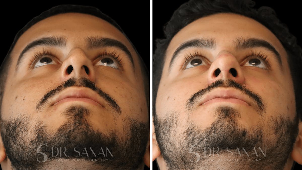Rhinoplasty Before & After Gallery - Patient 890465 - Image 5