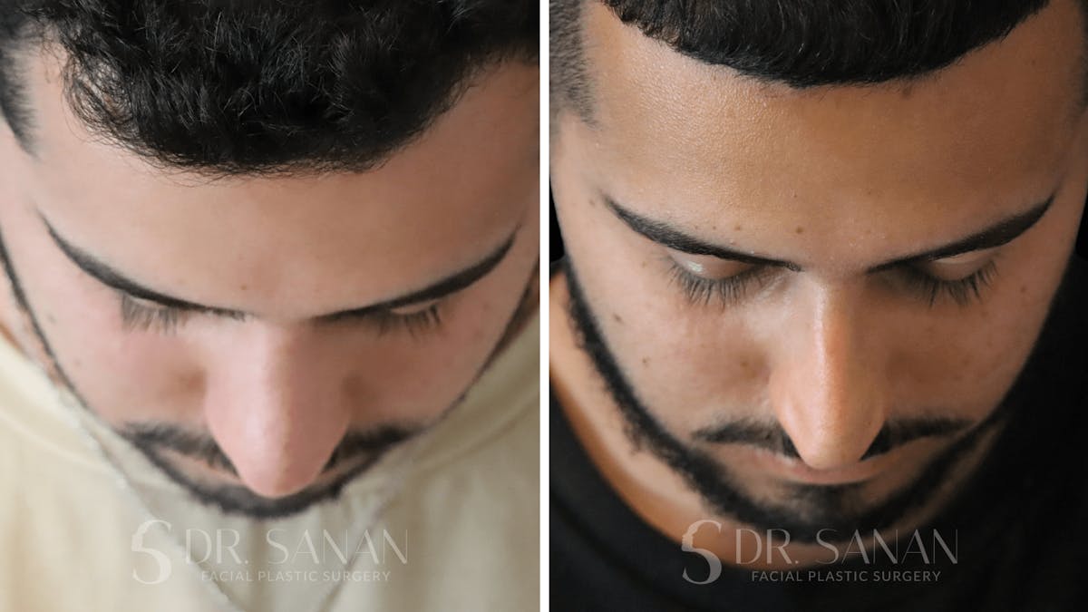 Rhinoplasty Before & After Gallery - Patient 890465 - Image 6