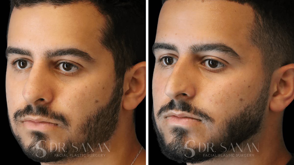 Rhinoplasty Before & After Gallery - Patient 890465 - Image 7
