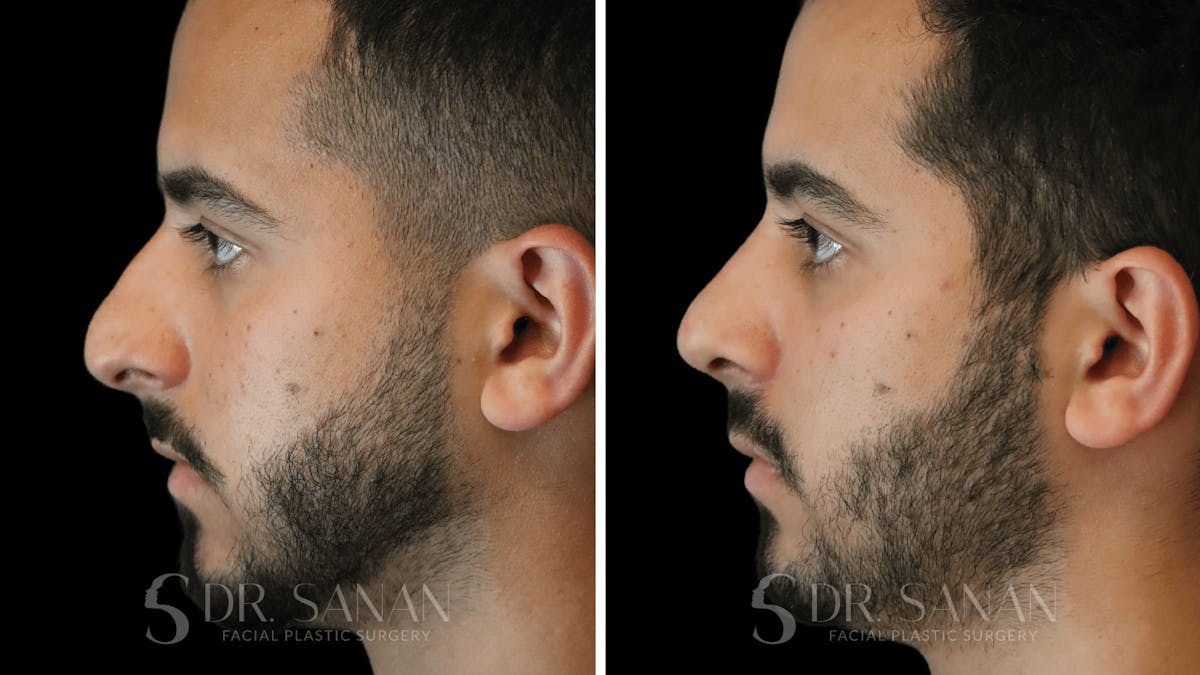Rhinoplasty Before & After Gallery - Patient 890465 - Image 2