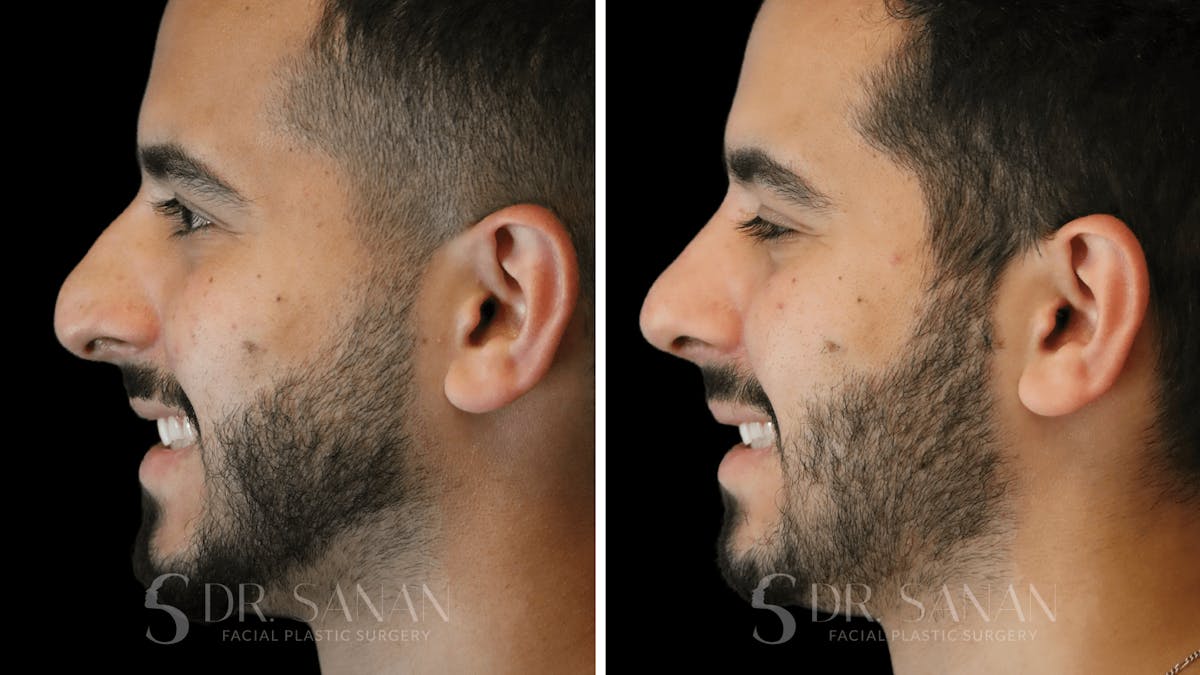 Rhinoplasty Before & After Gallery - Patient 890465 - Image 8