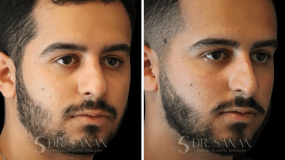 Rhinoplasty Before & After Gallery - Patient 890465 - Image 9