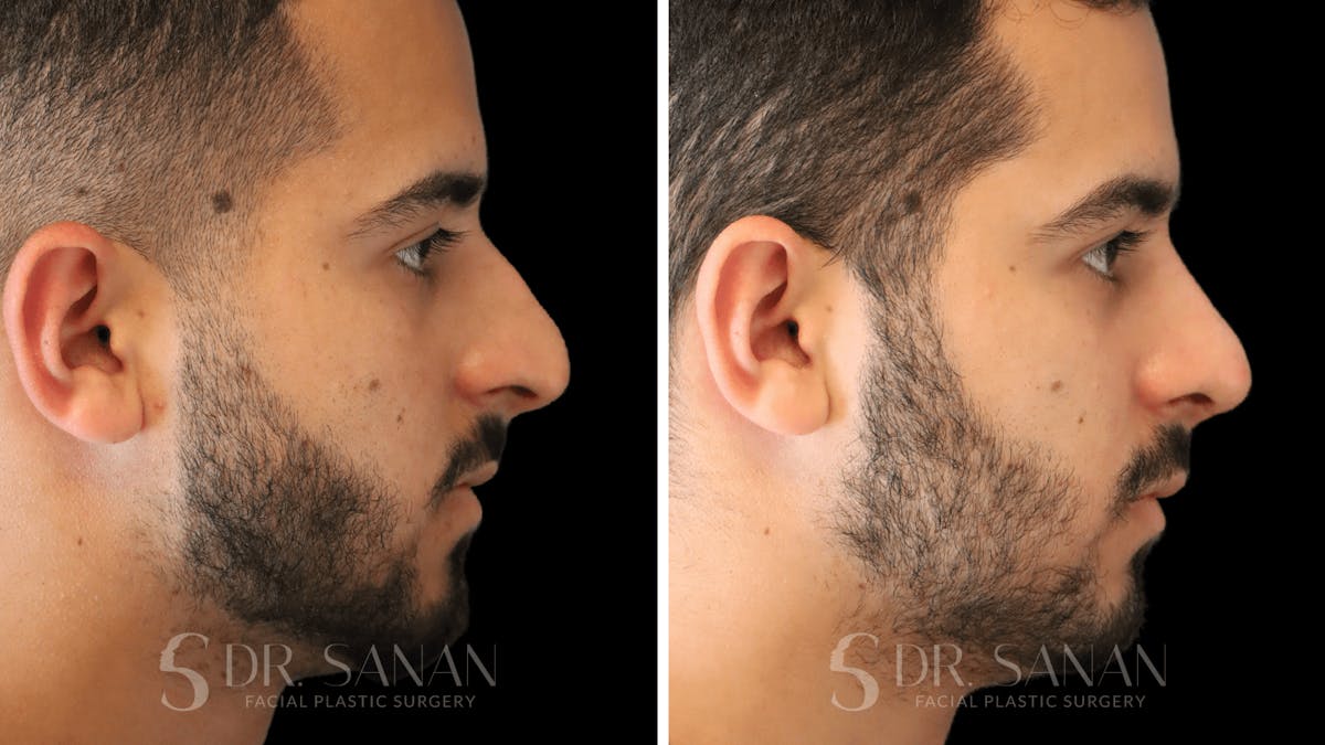 Rhinoplasty Before & After Gallery - Patient 890465 - Image 1