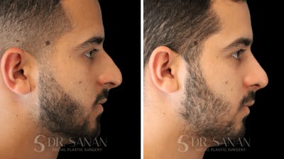 Rhinoplasty Before & After Gallery - Patient 890465 - Image 1
