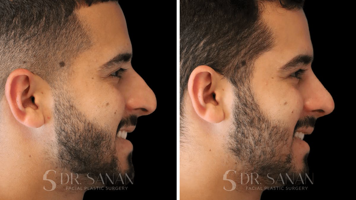 Rhinoplasty Before & After Gallery - Patient 890465 - Image 10