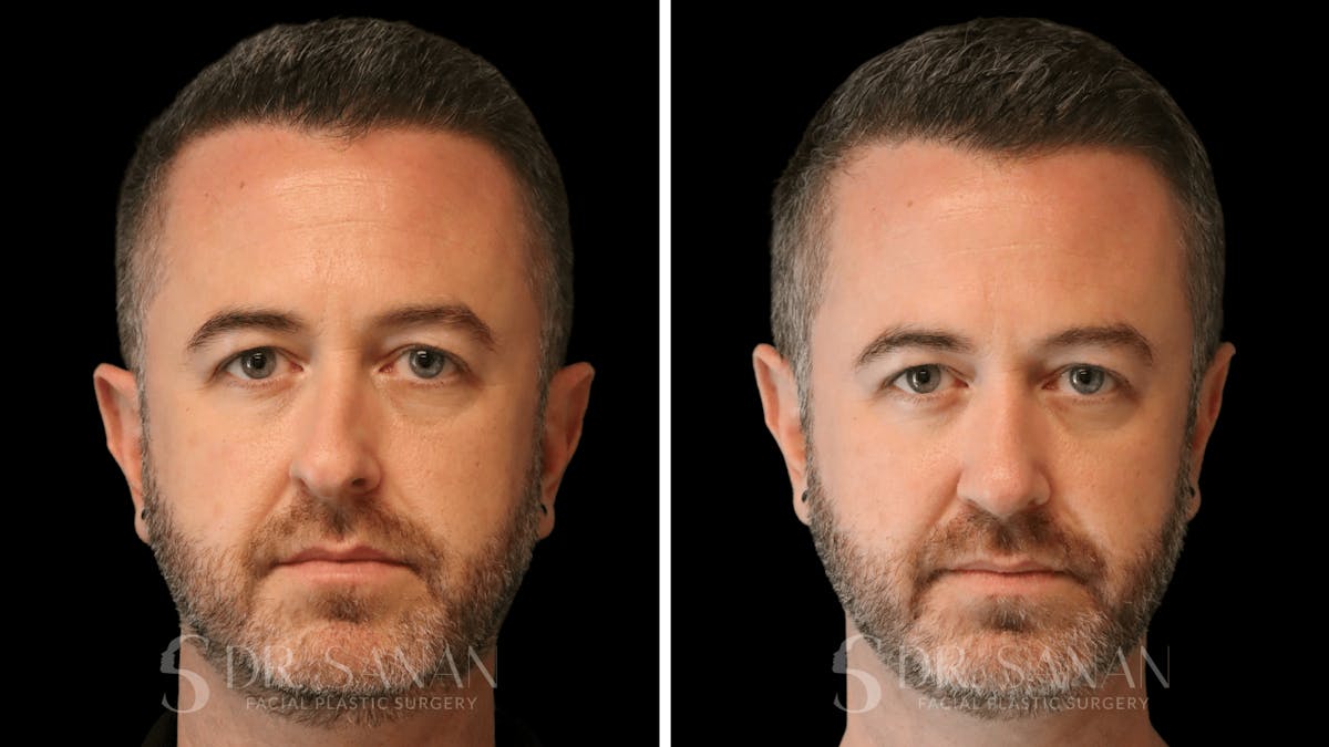Rhinoplasty Before & After Gallery - Patient 117229 - Image 3