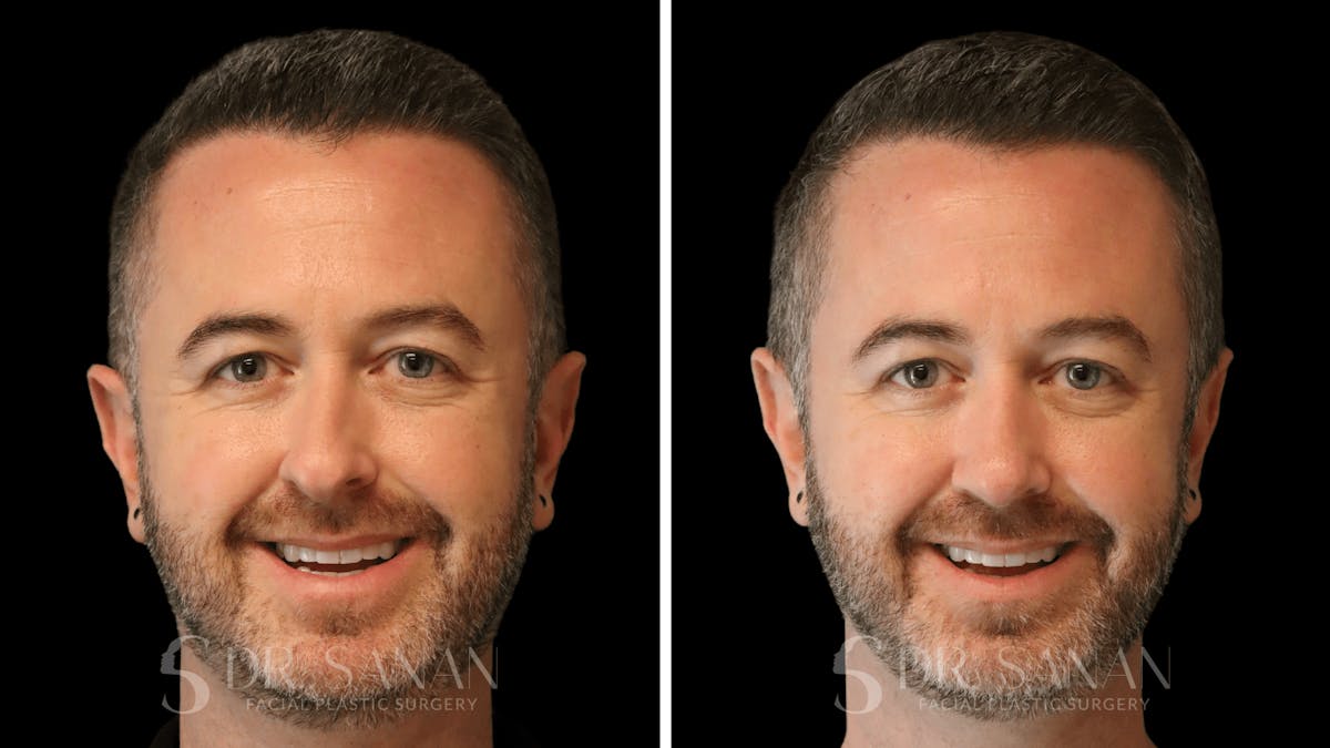 Rhinoplasty Before & After Gallery - Patient 117229 - Image 4