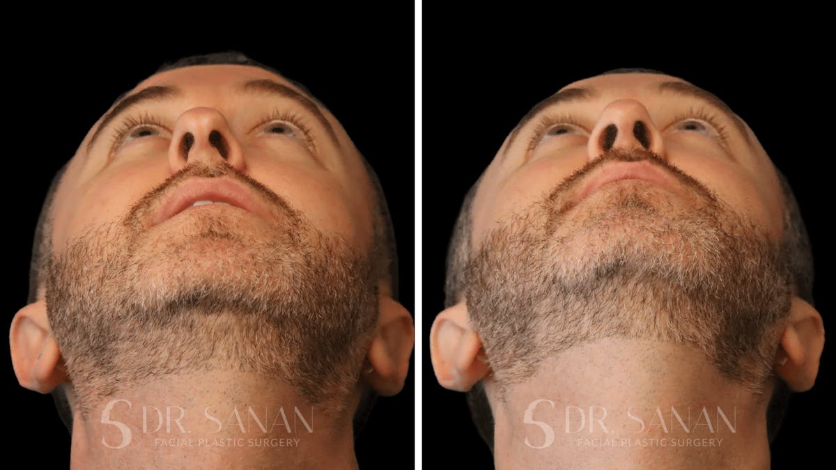 Rhinoplasty Before & After Gallery - Patient 117229 - Image 5