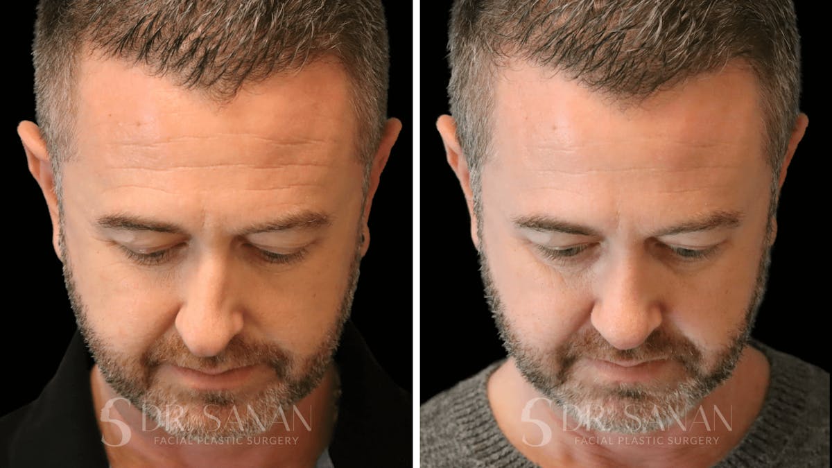 Rhinoplasty Before & After Gallery - Patient 117229 - Image 6