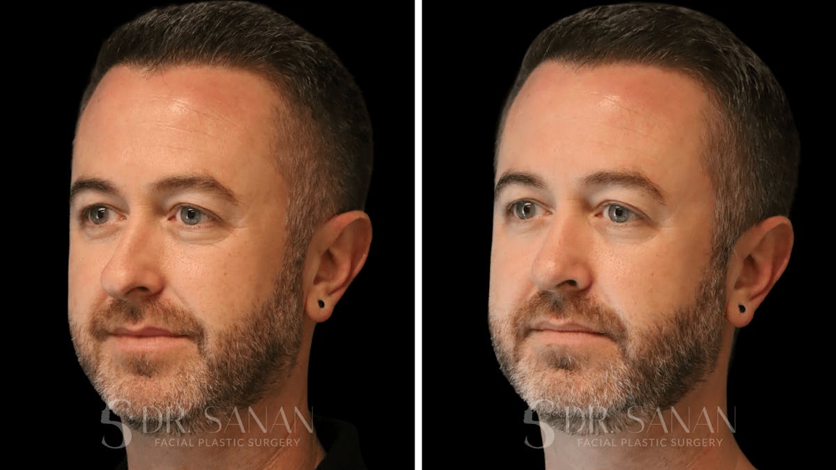 Rhinoplasty Before & After Gallery - Patient 117229 - Image 7