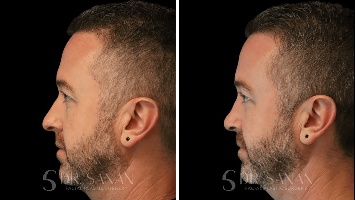 Rhinoplasty Before & After Gallery - Patient 117229 - Image 2