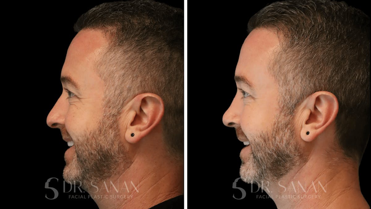 Rhinoplasty Before & After Gallery - Patient 117229 - Image 8