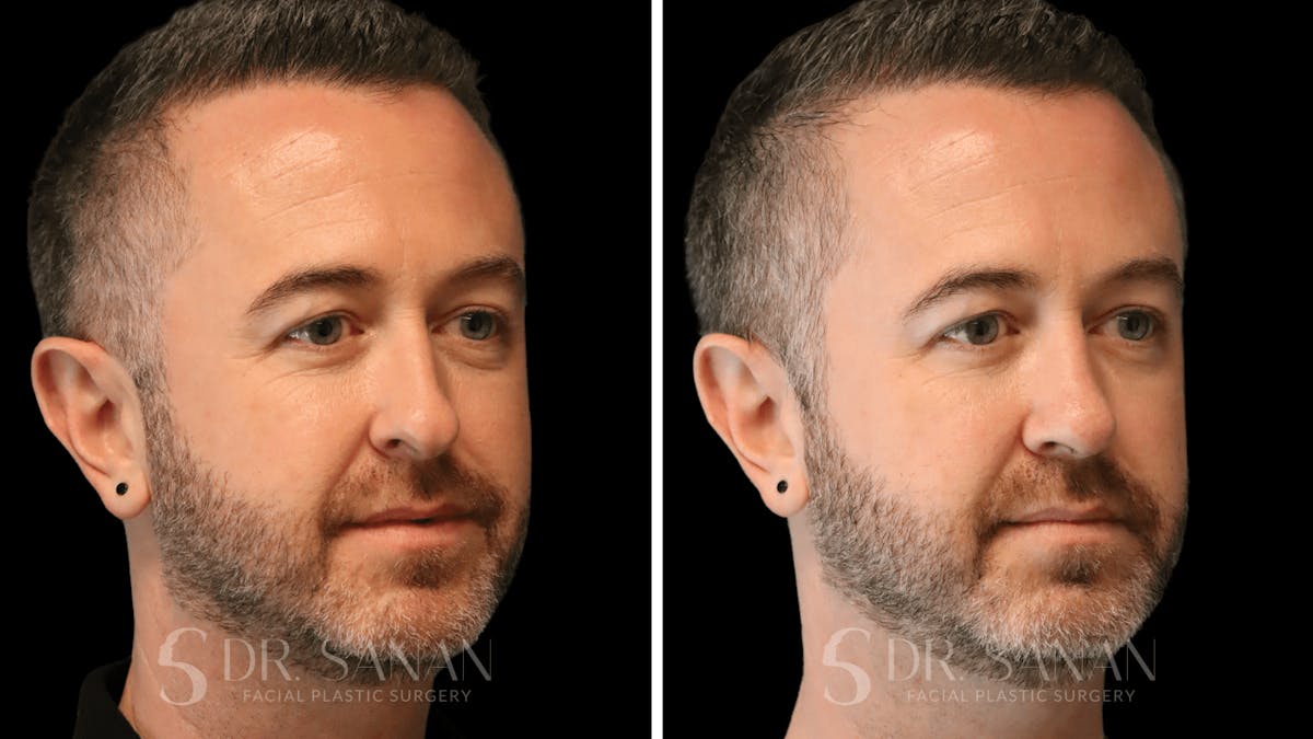 Rhinoplasty Before & After Gallery - Patient 117229 - Image 9