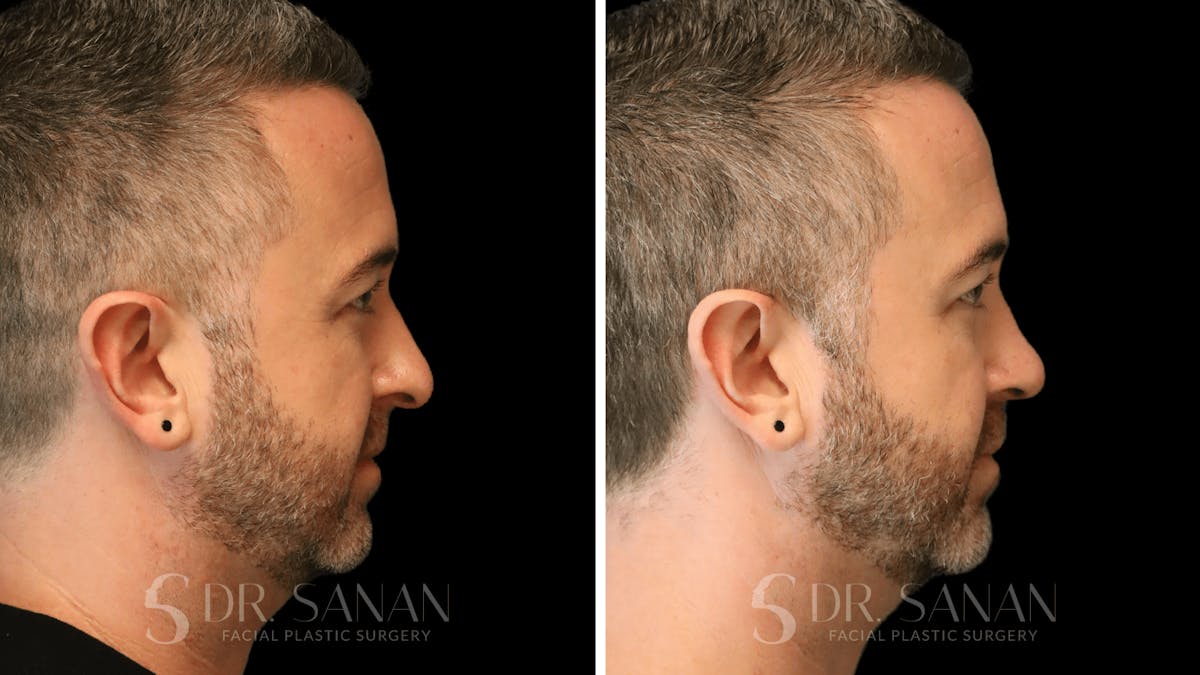 Rhinoplasty Before & After Gallery - Patient 117229 - Image 1