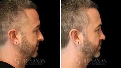 Rhinoplasty Before & After Gallery - Patient 117229 - Image 1