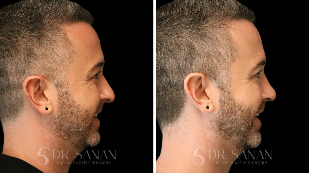 Rhinoplasty Before & After Gallery - Patient 117229 - Image 10