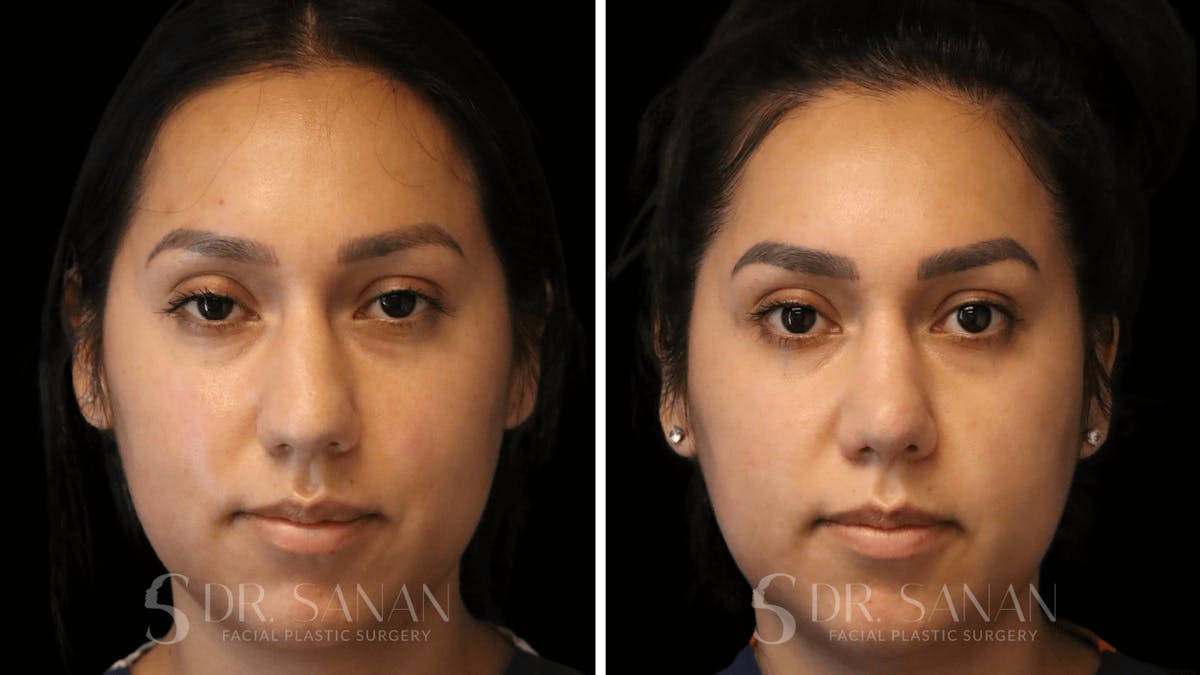 Rhinoplasty Before & After Gallery - Patient 118977 - Image 3