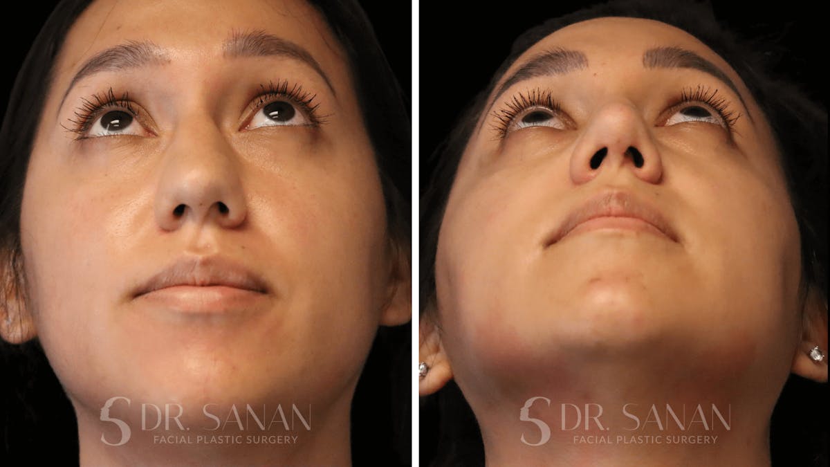 Rhinoplasty Before & After Gallery - Patient 118977 - Image 4