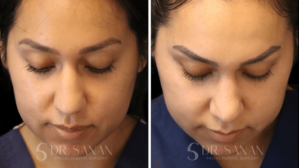 Rhinoplasty Before & After Gallery - Patient 118977 - Image 5