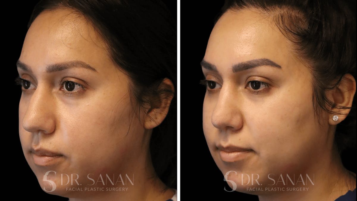 Rhinoplasty Before & After Gallery - Patient 118977 - Image 2