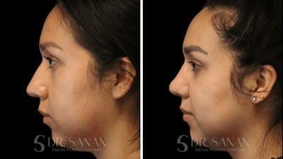 Rhinoplasty Before & After Gallery - Patient 118977 - Image 1