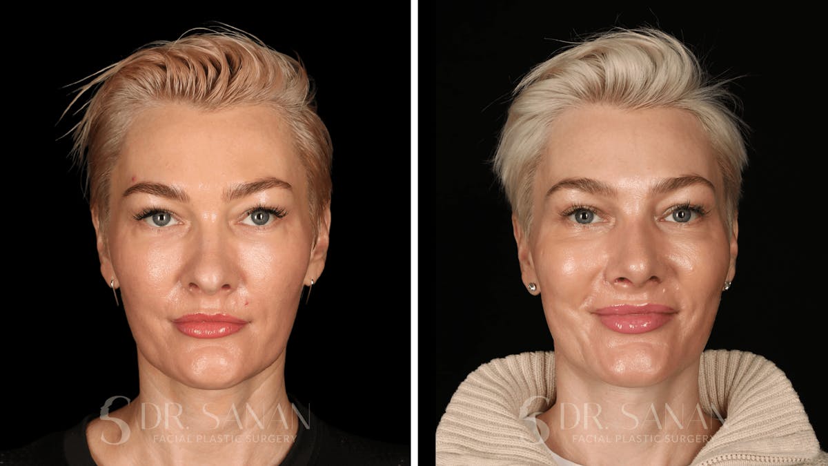 Rhinoplasty Before & After Gallery - Patient 220805 - Image 4