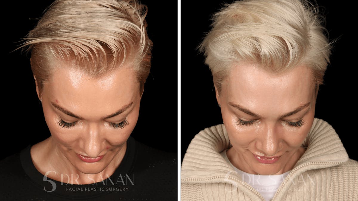 Rhinoplasty Before & After Gallery - Patient 220805 - Image 5