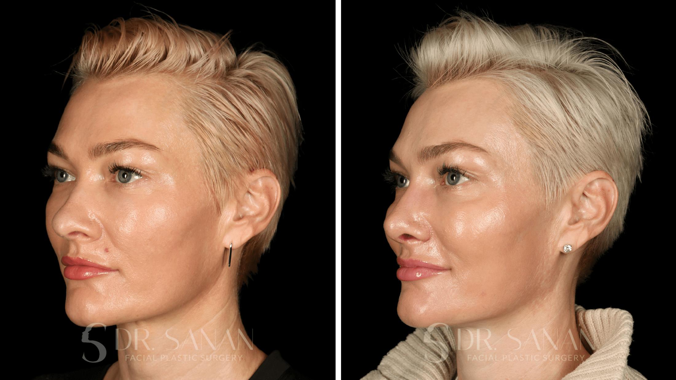 Rhinoplasty Before & After Gallery - Patient 220805 - Image 3