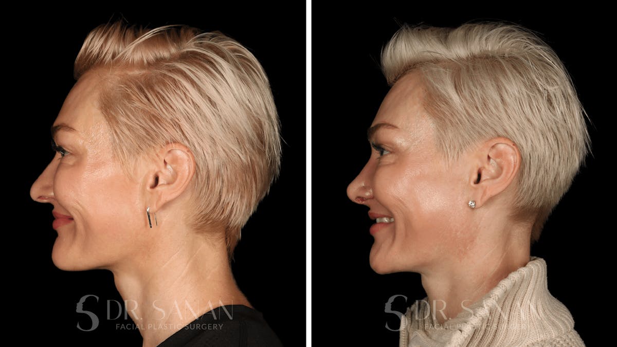 Rhinoplasty Before & After Gallery - Patient 220805 - Image 6